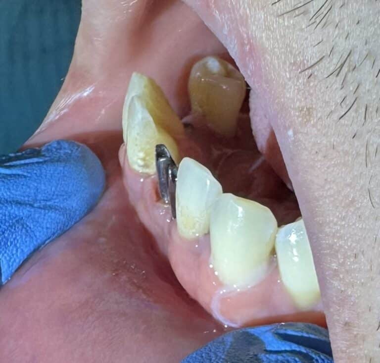 After Image: Immediate Placement of 2 Dental Implants after Extraction of Teeth in the Anterior Region of the Lower Jaw - front