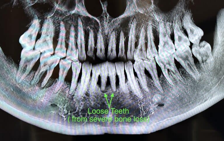 Before Image: Immediate Placement of 2 Dental Implants after Extraction of Teeth in the Anterior Region of the Lower Jaw - front