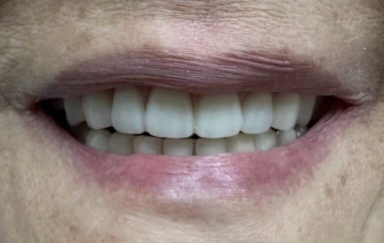 After Image: Upper Full-Arch  Fixed 6 Implants Implant Prosthesis with Bilateral Sinus Augmentation (External Sinus Lift / Elevation) - front